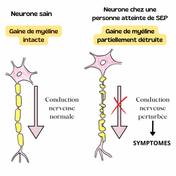 Schéma d'un neurone sain et d'un neurone en cas de sclérose en plaques